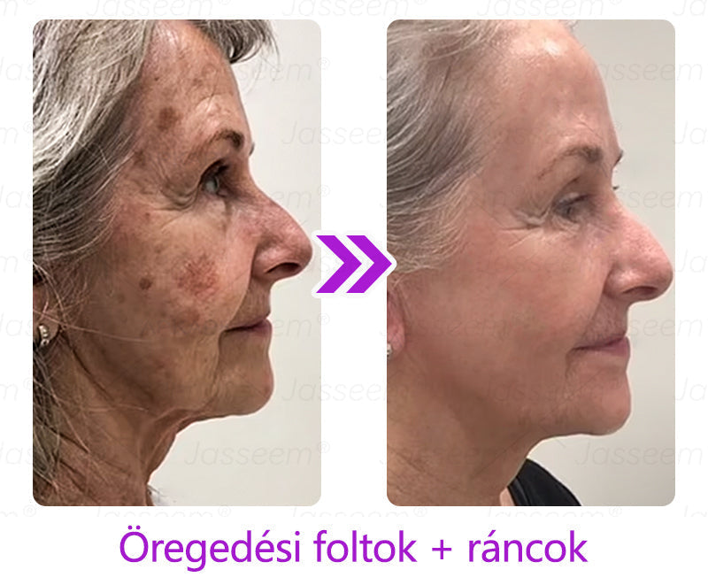đ„đ„đđđŹđŹđđđŠÂź Fejlett, nem invazĂv bĆrjavĂtĂł COâ lĂ©zeres toll đ (GyengĂ©den eltĂĄvolĂtja a szemölcsöket, anyajegyeket, öregsĂ©gi foltokat Ă©s bĆrkinövĂ©seket â fĂĄjdalom Ă©s gond nĂ©lkĂŒl!)