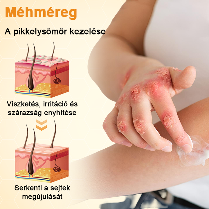 Timilk® BeeLieve Psoriasis bőrápolás🌿