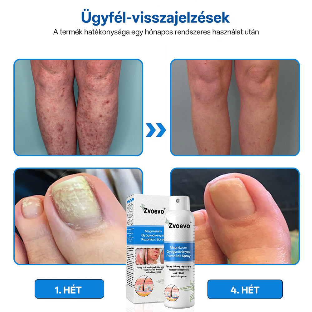 đ„đ„đ„ZvoevoÂź đMagnĂ©zium GyĂłgynövĂ©nyes PszoriĂĄzis Spray
