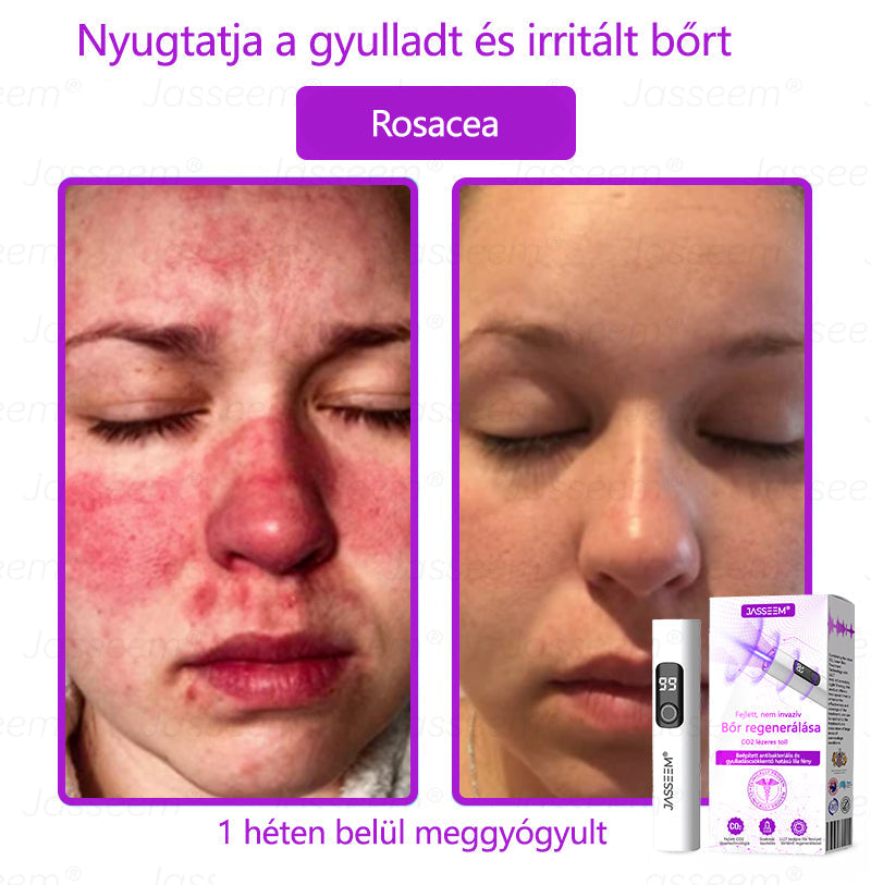 đ„đ„đđđŹđŹđđđŠÂź Fejlett, nem invazĂv bĆrjavĂtĂł COâ lĂ©zeres toll đ (GyengĂ©den eltĂĄvolĂtja a szemölcsöket, anyajegyeket, öregsĂ©gi foltokat Ă©s bĆrkinövĂ©seket â fĂĄjdalom Ă©s gond nĂ©lkĂŒl!)