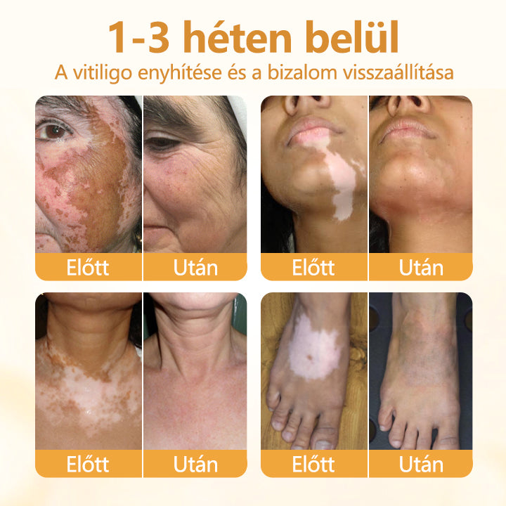 Timilk® VitiCalm méhméreg-krém🌻