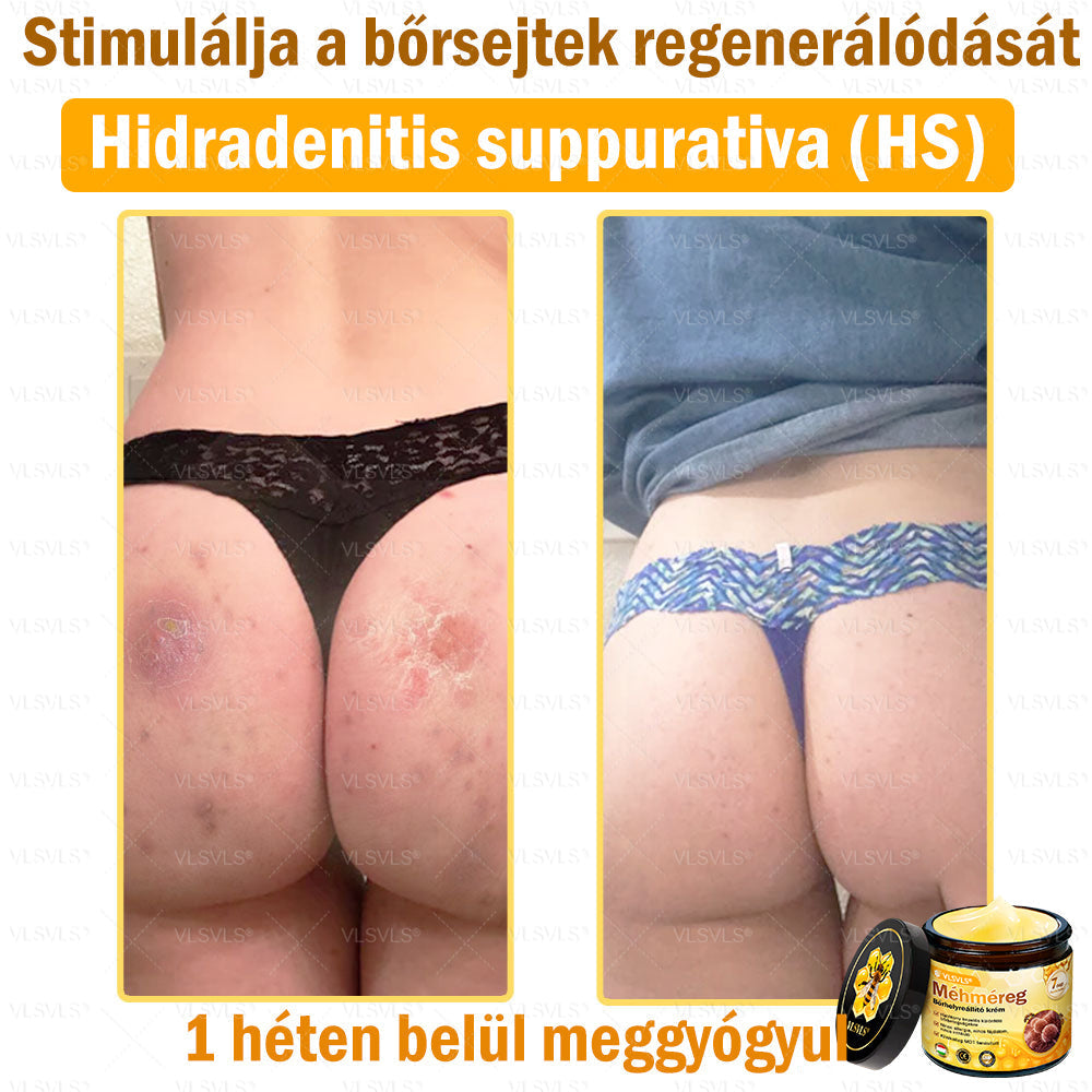 💪VLSVLS® Méhméreg Bőrhelyreállító Krém (👨‍⚕‍CE jóváhagyott)👍✅