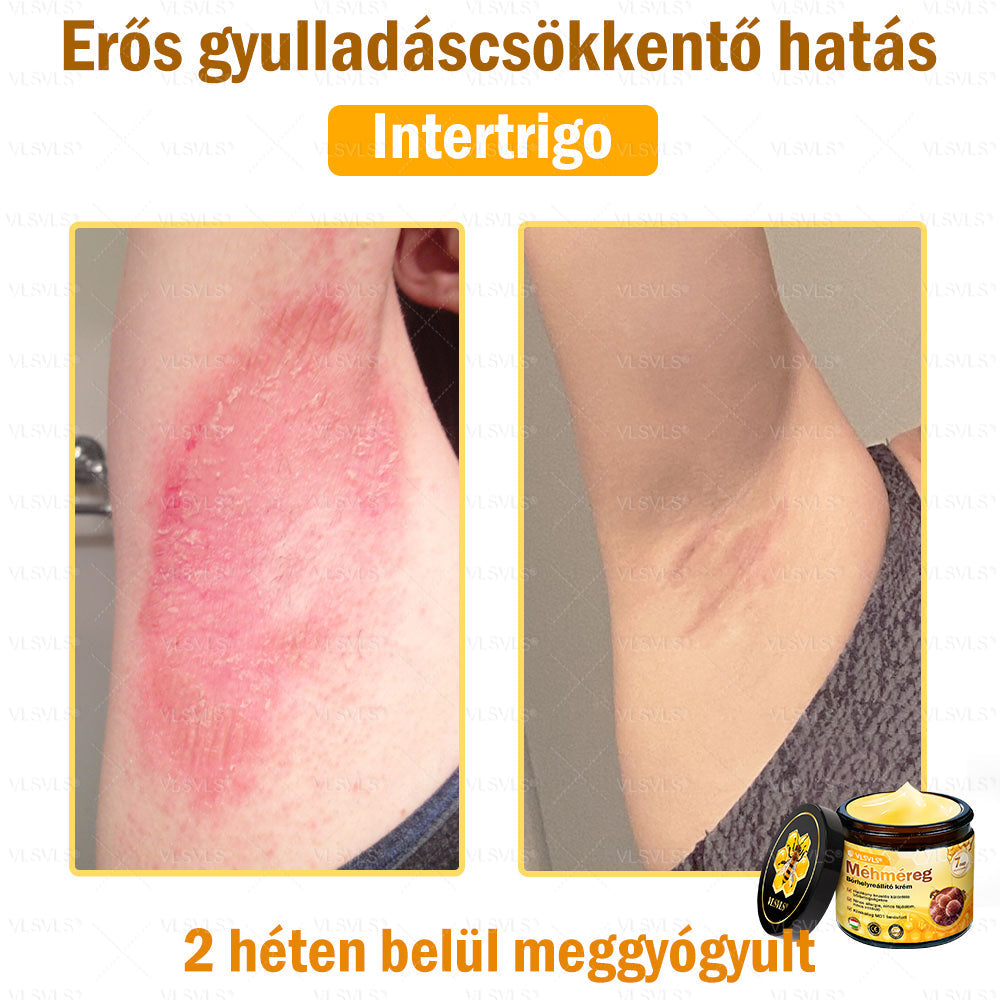 💪VLSVLS® Méhméreg Bőrhelyreállító Krém (👨‍⚕‍CE jóváhagyott)👍✅