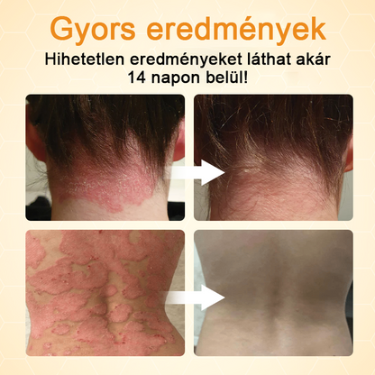 Timilk® BeeLieve Psoriasis bőrápolás🌿