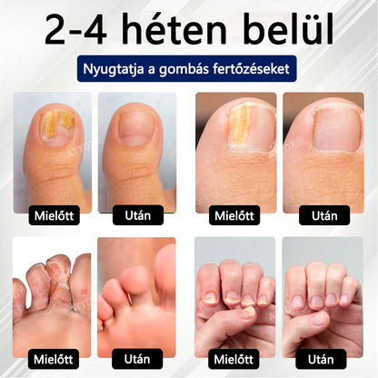 Croaie® Fungiclear Bee Therapy Nail Spray🎁🎁🎁