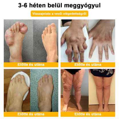 Aeehfeng™ méhméreg és kurkuma ízületi gyulladás terápiás krém (👩 🔬ortopédiai állapotokra és ízületi fájdalmakra👩 🔬 specializálódott)