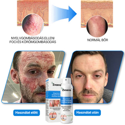 🔥🔥🔥Zvoevo® 🎉Magnézium Gyógynövényes Pszoriázis Spray