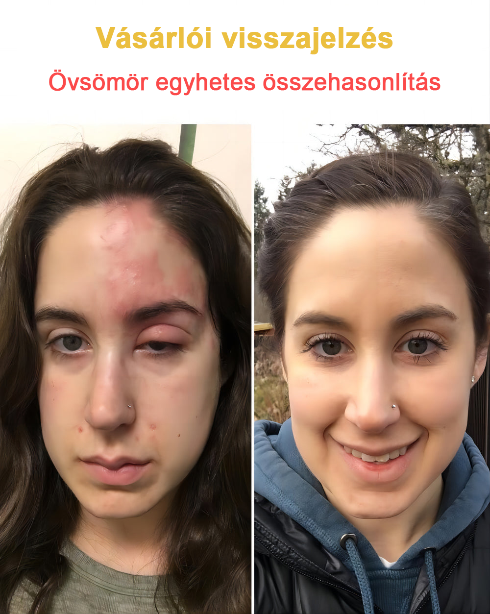 2024 ÚJ Velisse™ méhméreg bőrkrém（🧑‍⚕️AAD ajánlott), a szemölcsök, akné és hegek eltávolítására – többféle bőrbetegség kezelésére