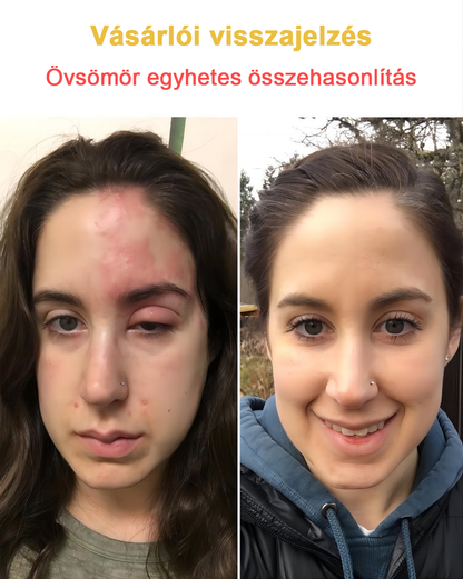 2024 ÚJ Velisse™ méhméreg bőrkrém（🧑‍⚕️AAD ajánlott), a szemölcsök, akné és hegek eltávolítására – többféle bőrbetegség kezelésére