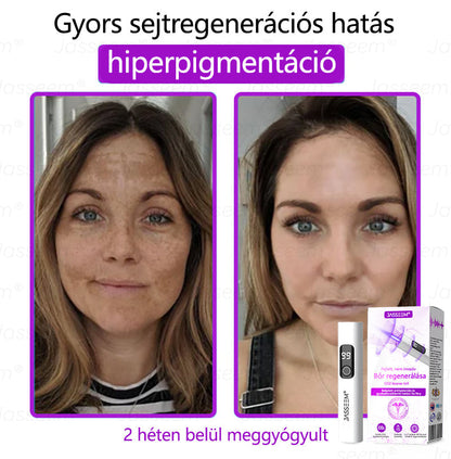 🔥🔥𝐉𝐚𝐬𝐬𝐞𝐞𝐦® Fejlett, nem invazív bőrjavító CO₂ lézeres toll 🎉 (Gyengéden eltávolítja a szemölcsöket, anyajegyeket, öregségi foltokat és bőrkinövéseket – fájdalom és gond nélkül!)