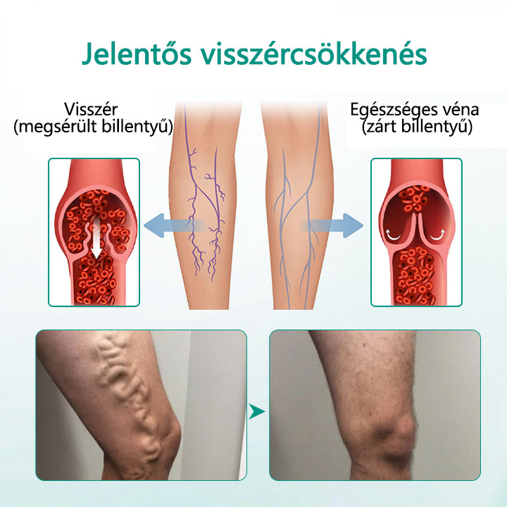 Timilk® LegRenew Visszér Tapasz