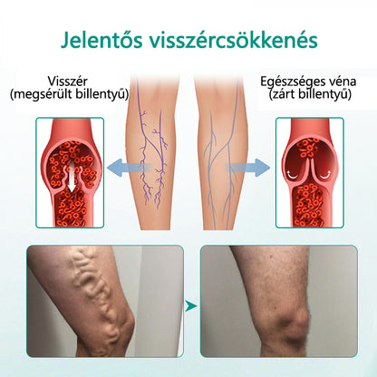 Timilk® LegRenew Visszér Tapasz