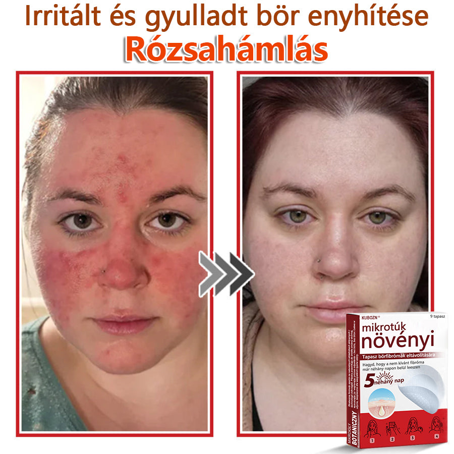 ✅KUBOZN® Mikrotűs Botanikus Bőrkinövés Eltávolító Tapaszok | Magyarországon készült