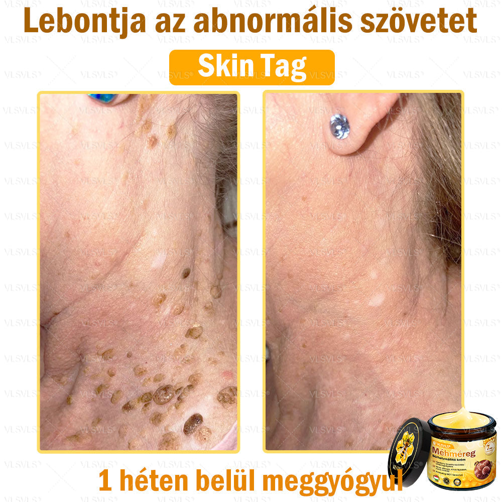 💪VLSVLS® Méhméreg Bőrhelyreállító Krém (👨‍⚕‍CE jóváhagyott)👍✅