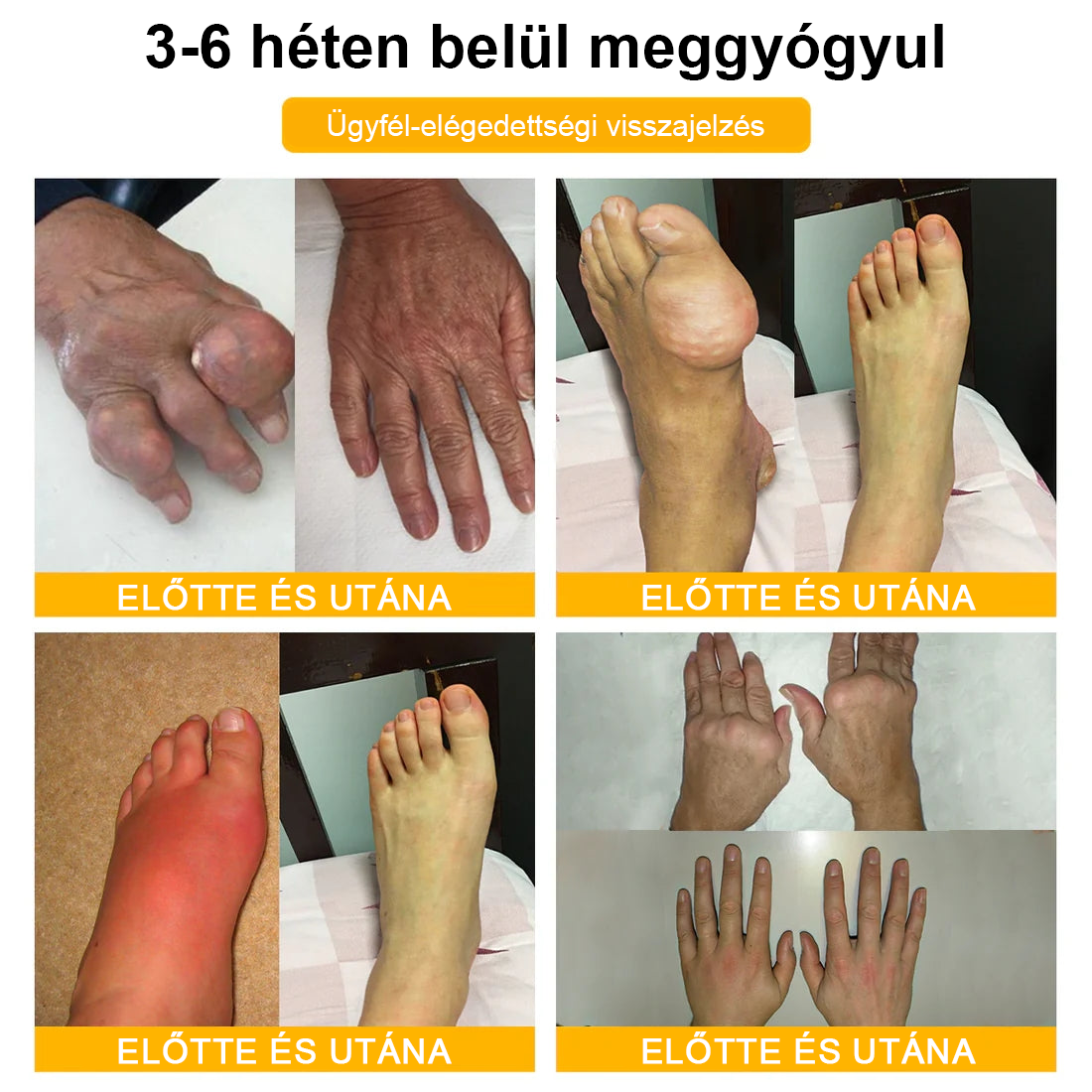 TLOPA® Botulinum Toxin és Méhméreg Fájdalomcsillapító Csontgyógyító Krém🐝 🔥(Kifejezetten időseknek & ortopéd szakorvosok ajánlásával)