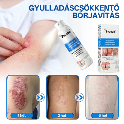 🔥🔥🔥Zvoevo® 🎉Magnézium Gyógynövényes Pszoriázis Spray