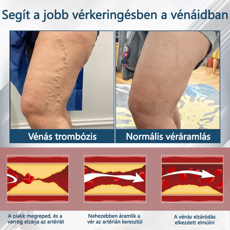 👨‍⚕️👨‍⚕️👨‍⚕️ATTDX® Növényi ödéma enyhítő krém nigellával