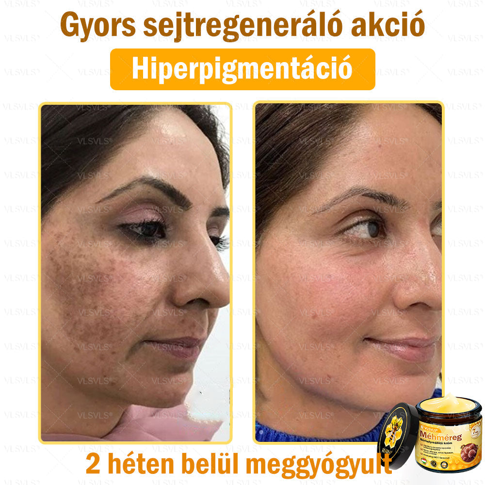 💪VLSVLS® Méhméreg Bőrhelyreállító Krém (👨‍⚕‍CE jóváhagyott)👍✅